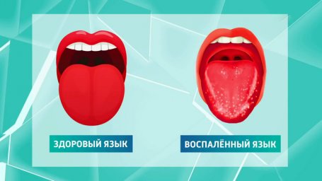 О каких заболеваниях язык расскажет без слов